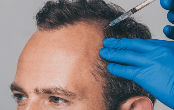 Dutasterida Inyecciones Para La Alopecia CIO Salud