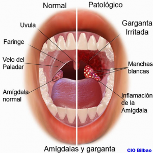 cirugía-amigdalitis