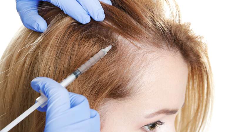 tratamiento alopecia inyecciones