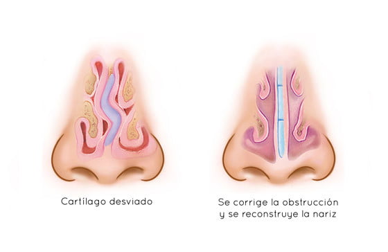 rinoplastia nariz rota