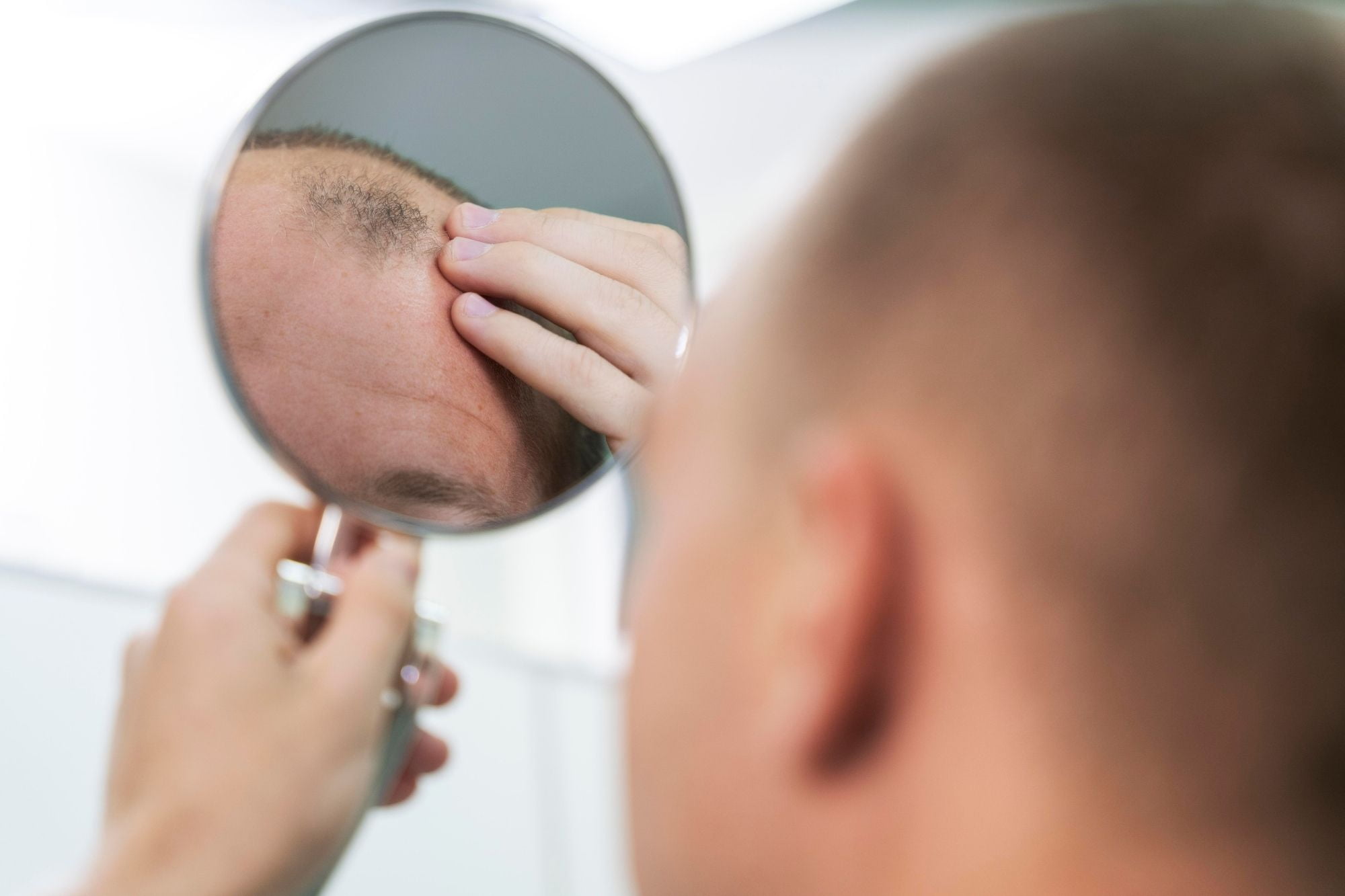 Tipos de alopecia masculina