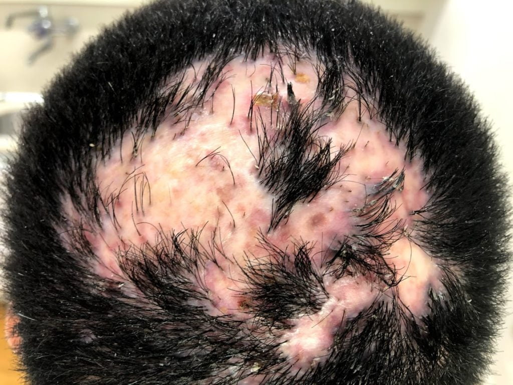 causas celulitis disecante del cuero cabelludo