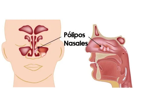 cirugía pólipos nasales