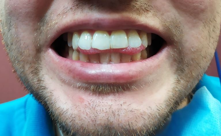 Cómo evitar empujar los dientes con la lengua