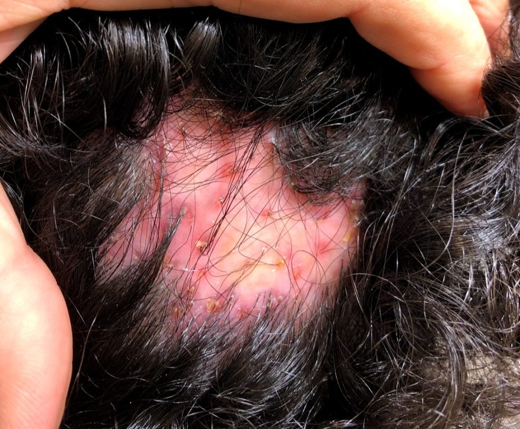 tratamiento celulitis disecante del cuero cabelludo