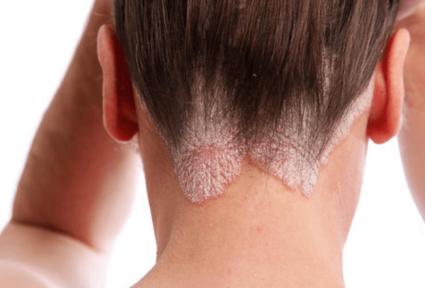 Dermatitis Seborreica Tipos Y Tratamientos Cio Salud