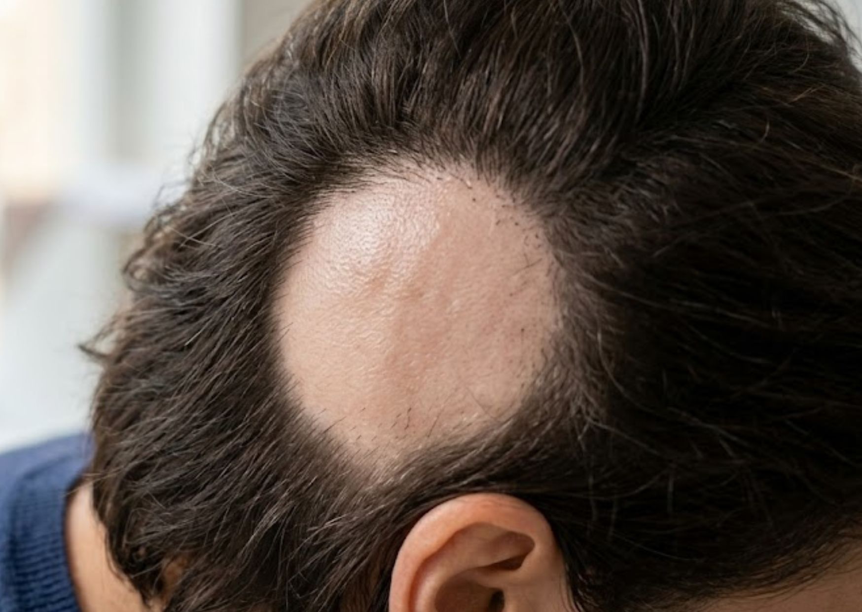 Alopecia Areata: Síntomas, causas y tratamiento
