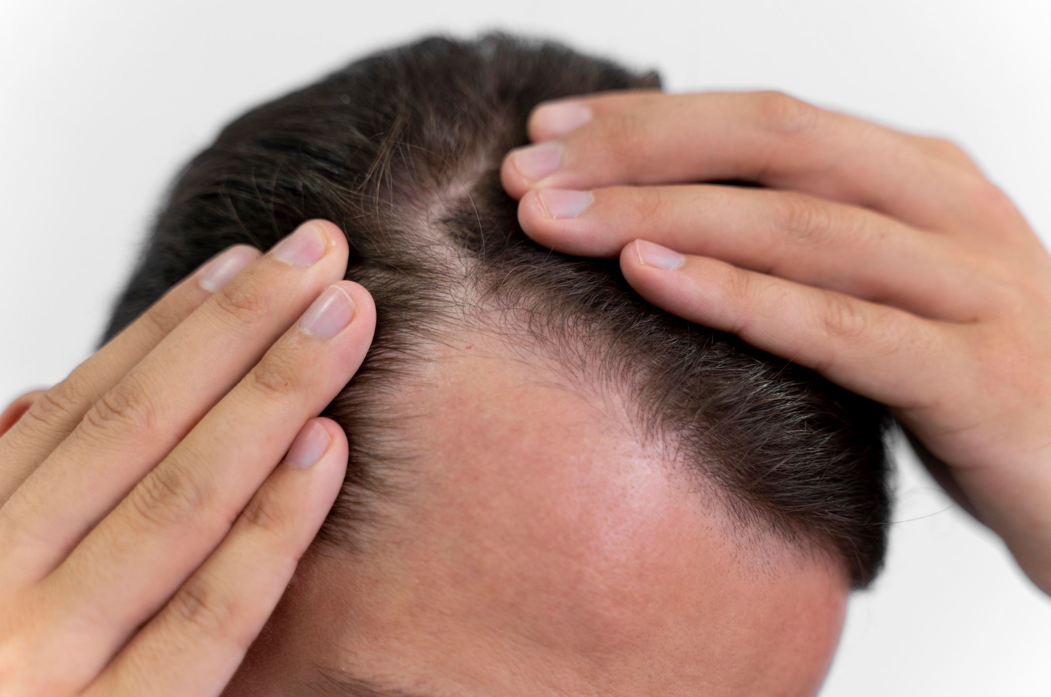 Alopecia difusa masculina, origen, causas y tratamiento - CIO