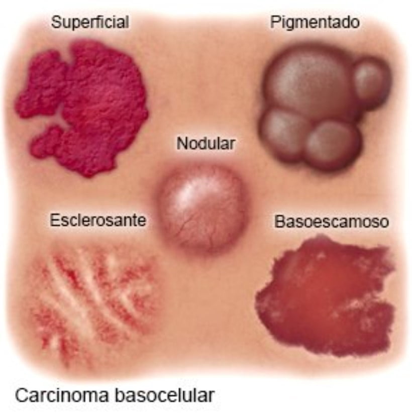 Tipos de carcinoma de células basales