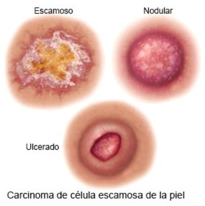 Tipos de carcinoma de células escamosas