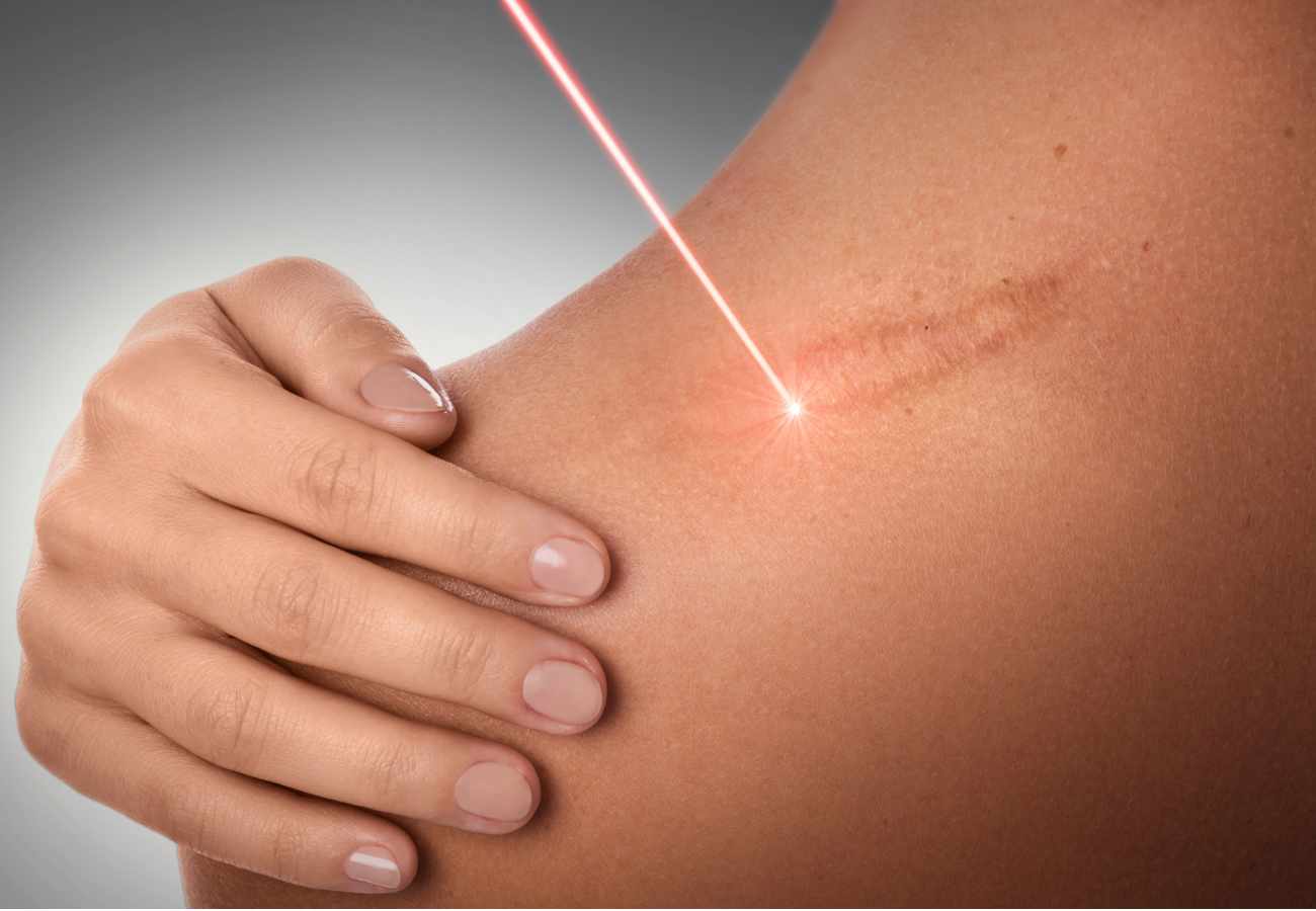 Cómo eliminar una cicatriz: Tratamientos dermatológicos