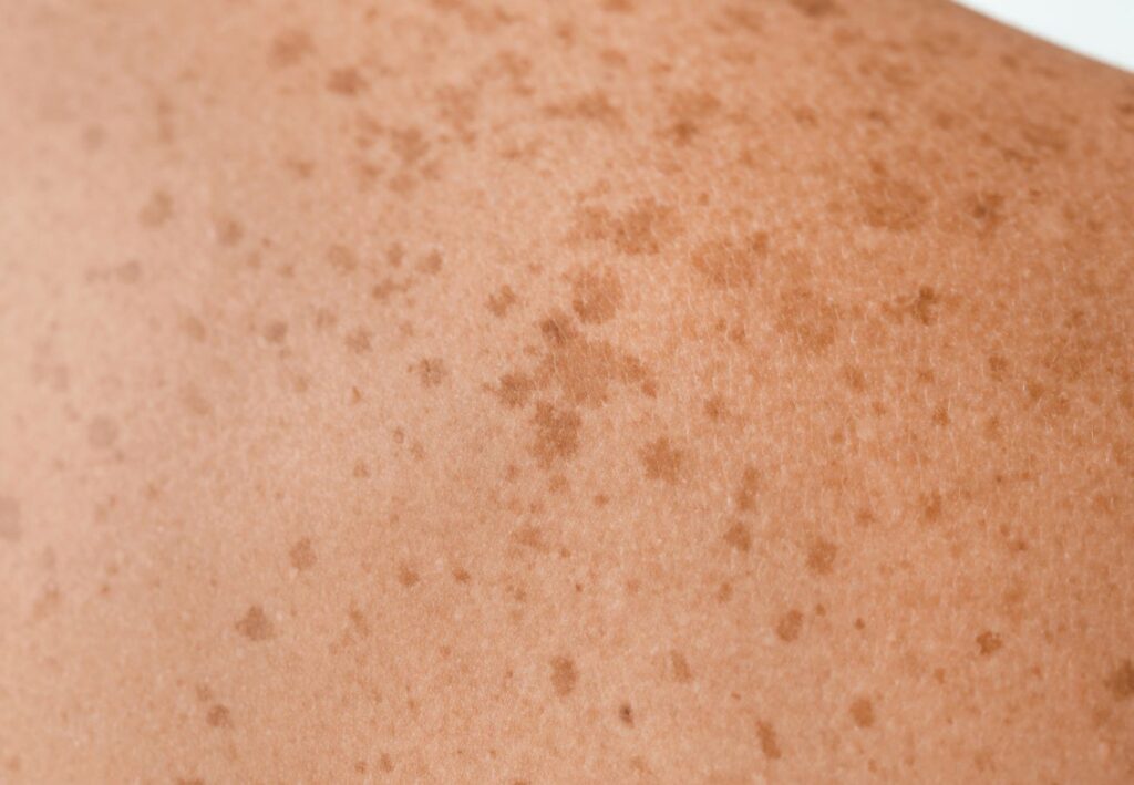 consejos cáncer de piel