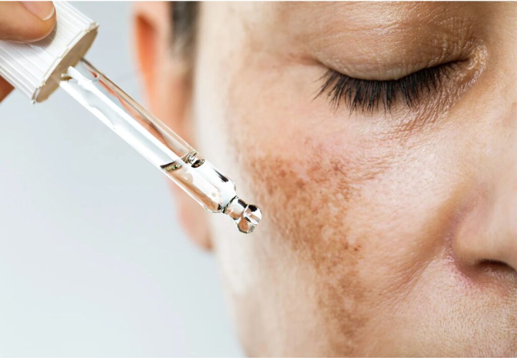 melasma