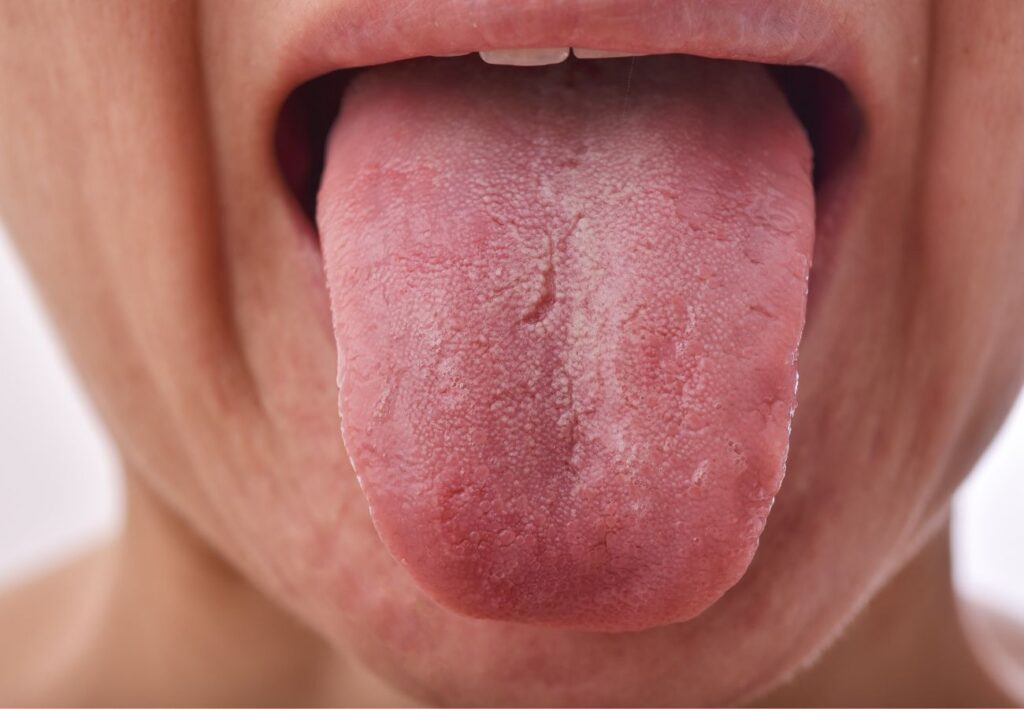 síndrome boca seca