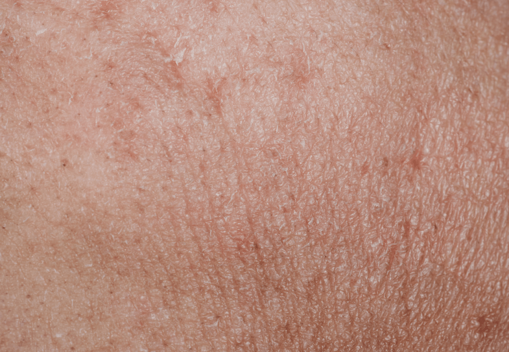 síntomas piel seca