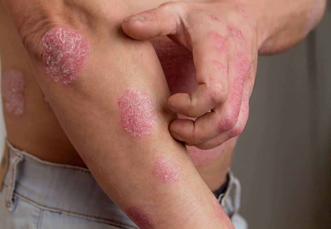 Tratamiento del eczema: Estrategia y cuidados efectivos
