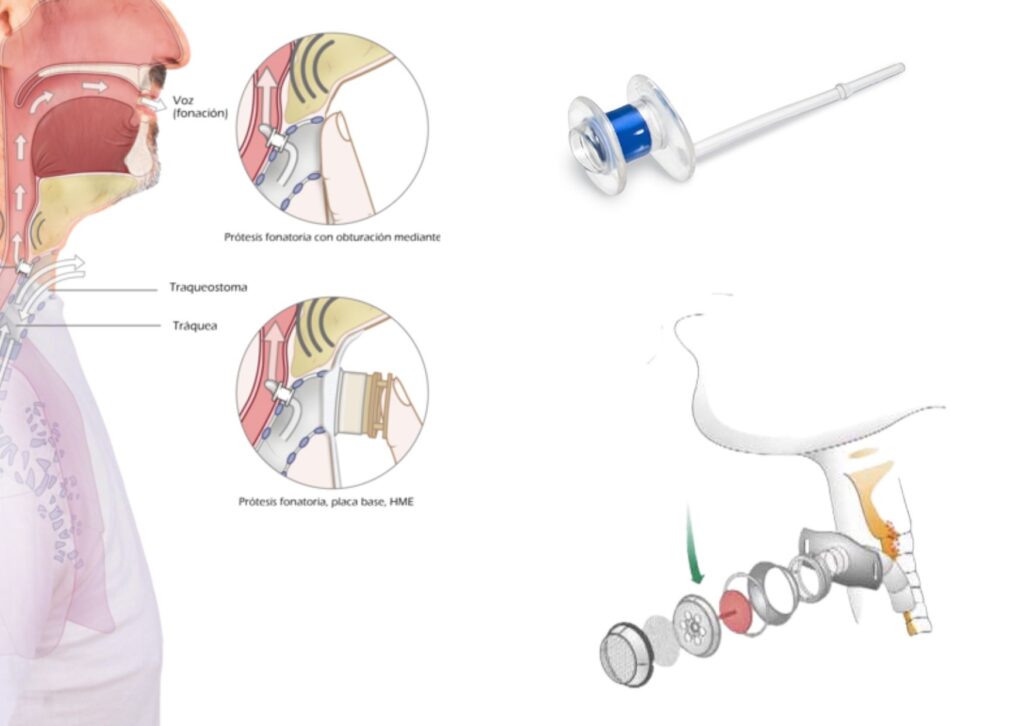 cómo recuperar la voz