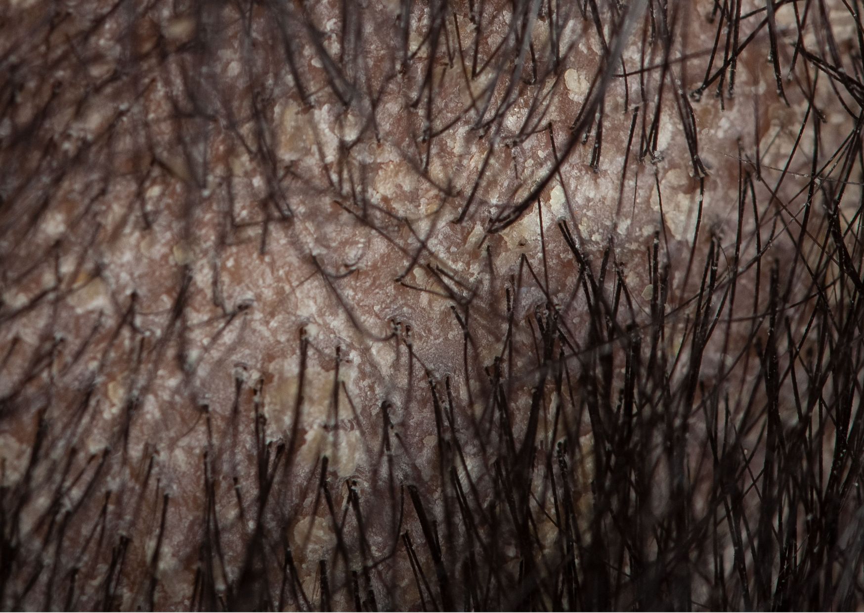 Dermatitis seborreica en cuero cabelludo - CIO Salud