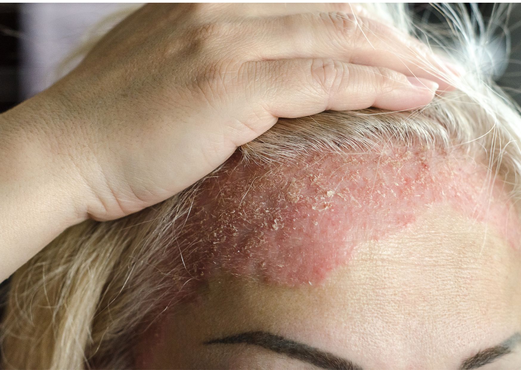 dermatitis en la cara