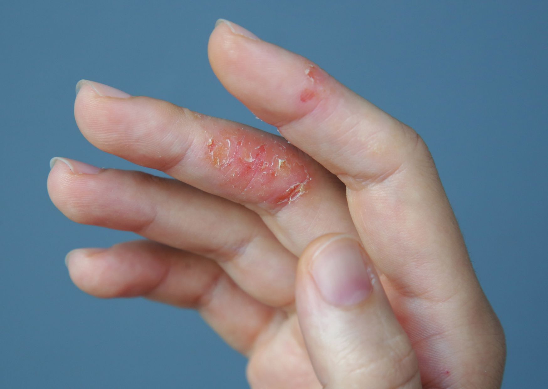 dermatitis en las manos