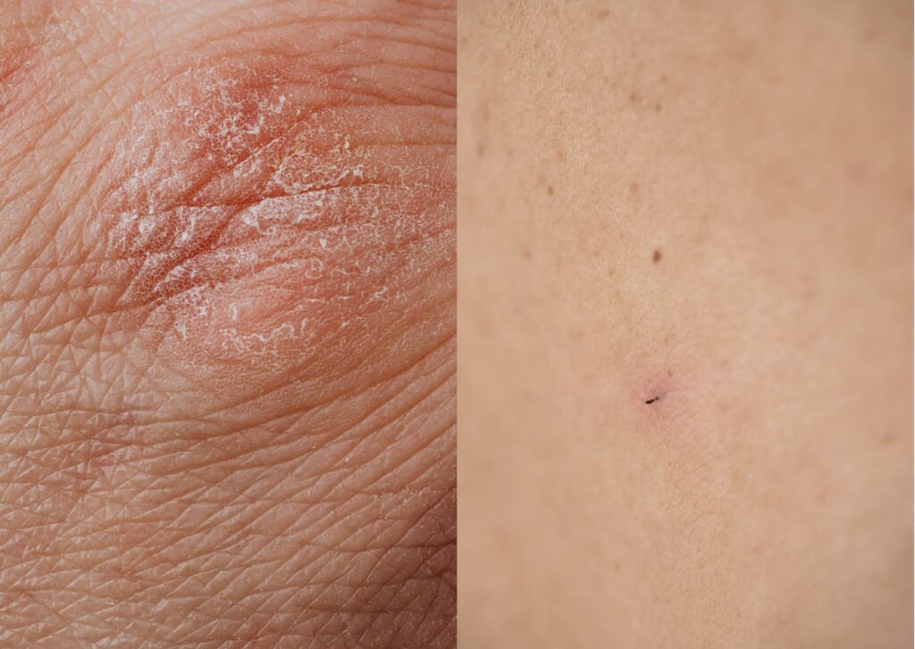 eczema qué es