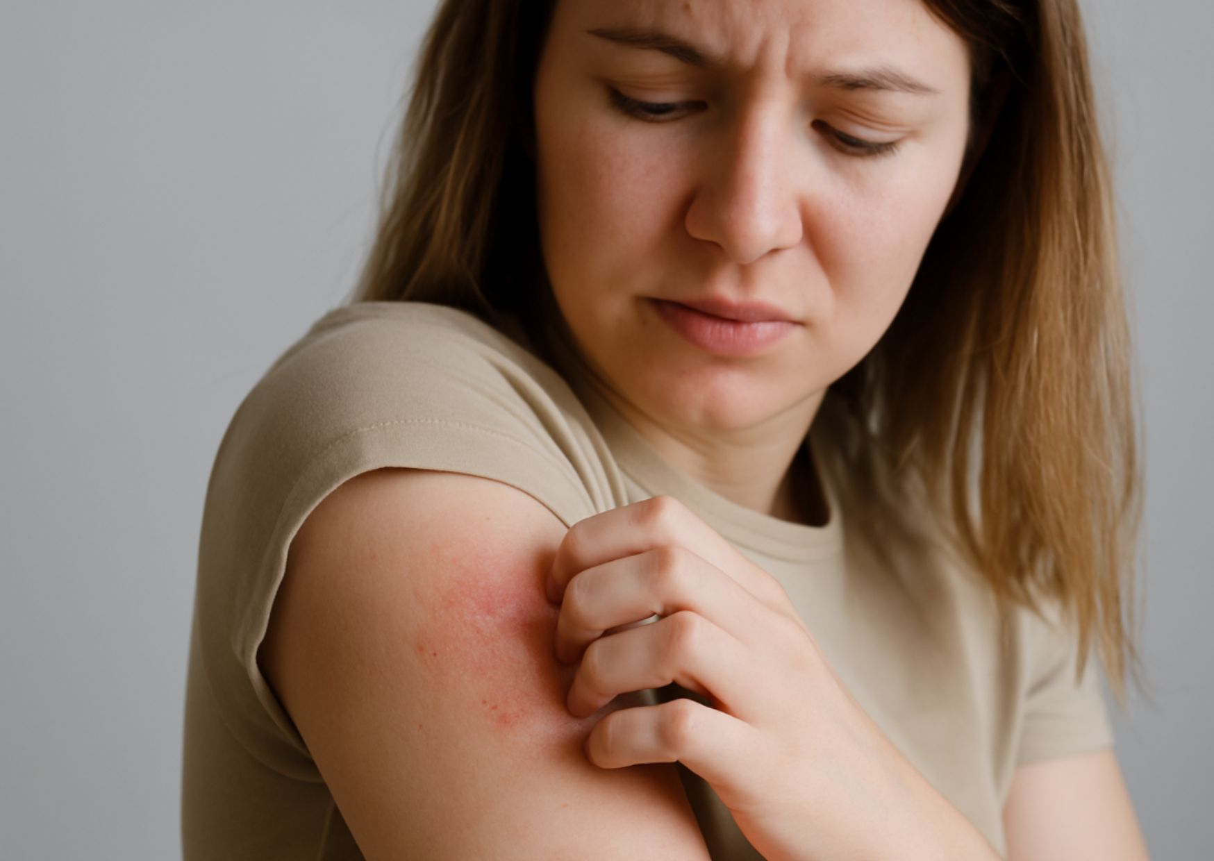 Qué es un eczema y cómo tratarlo de forma natural