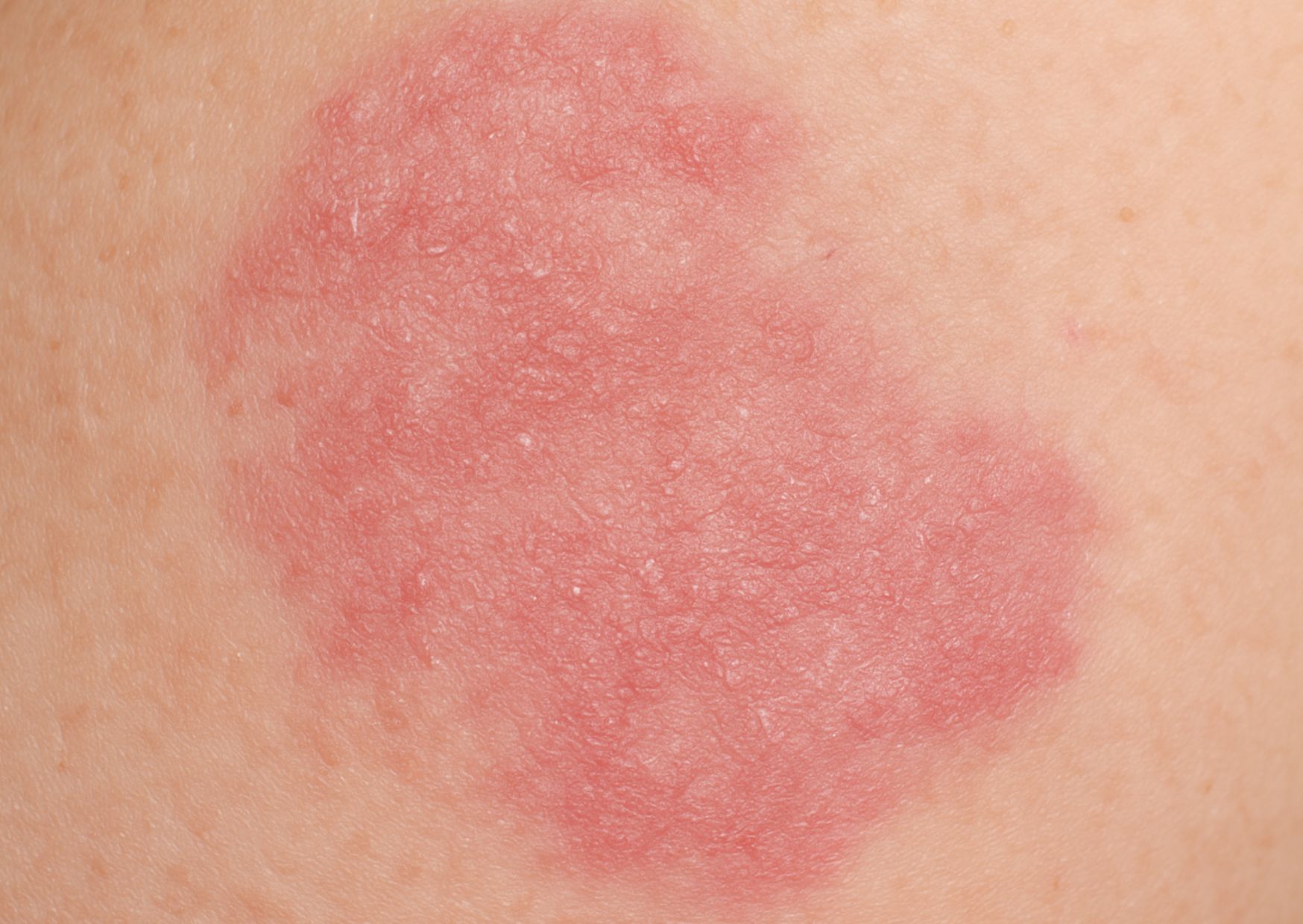 Dermatitis atópica en adultos: causas, síntomas y tratamiento