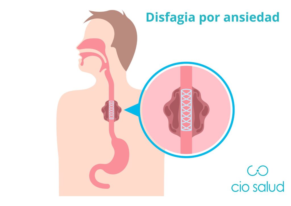 disfagia nerviosa