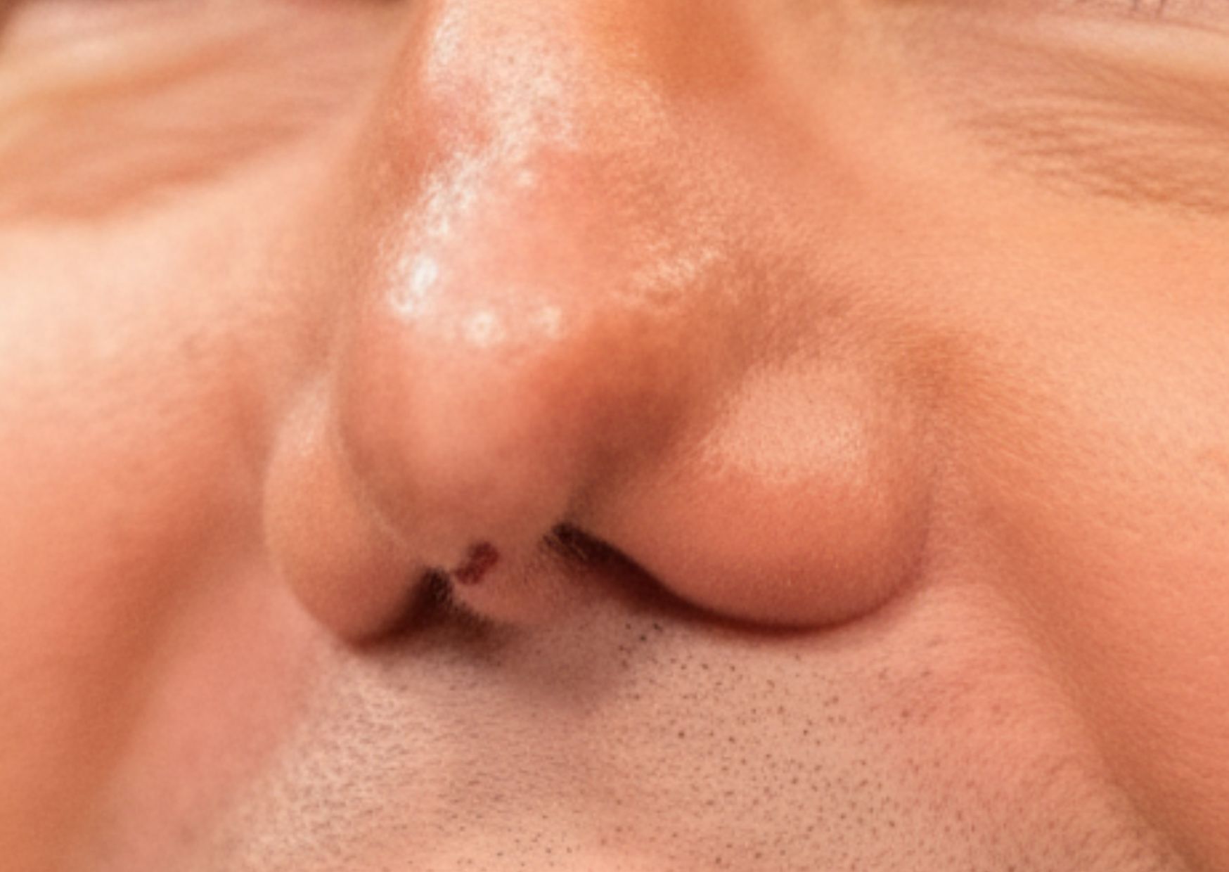 Rinoplastia Low Cost, ¿conoces los riesgos?