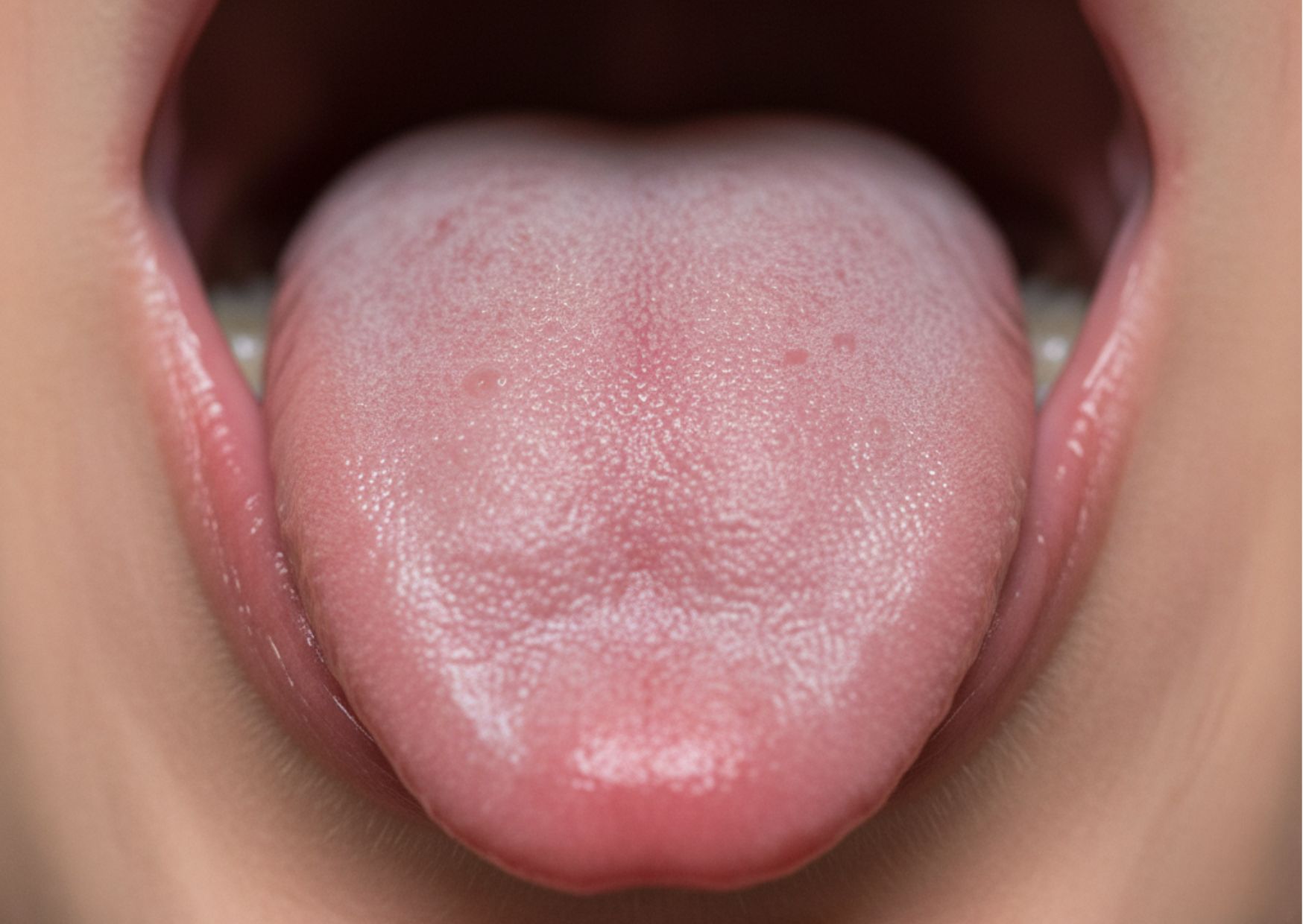 Sialolitiasis. Cálculos de la glándula salival