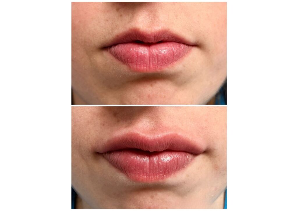 rellano de labios ácido hialurónico