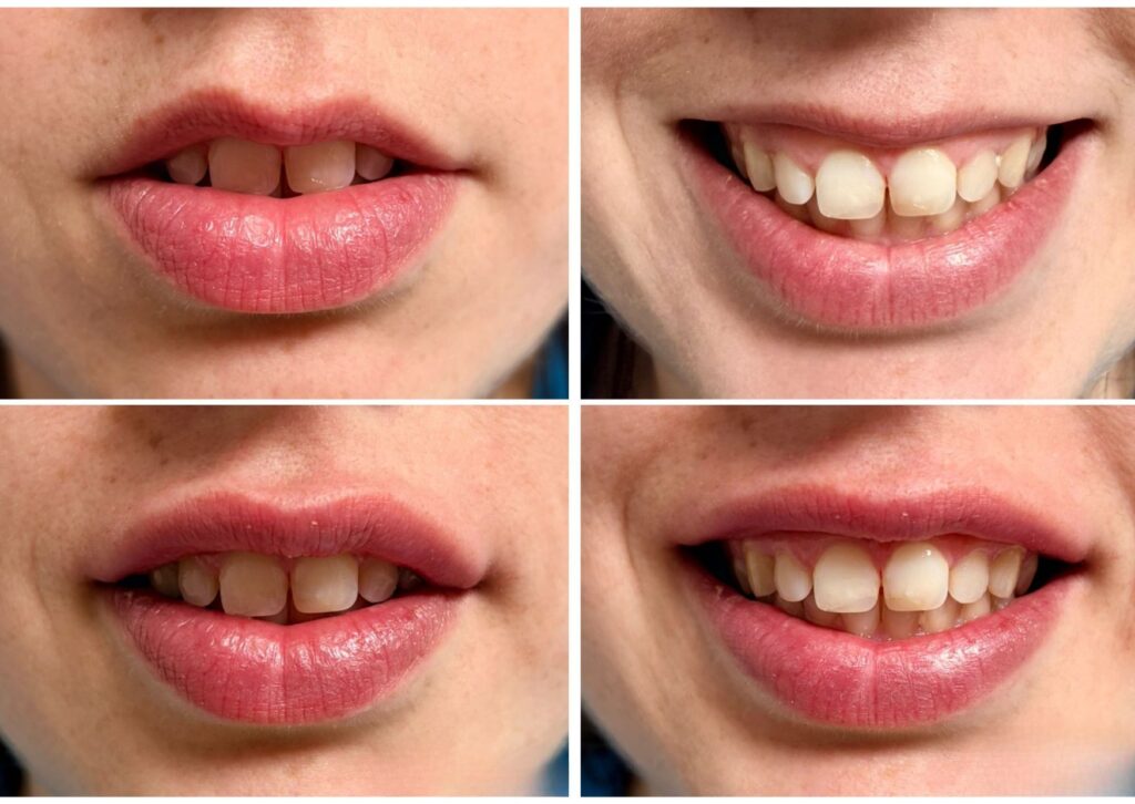 relleno de labios Bilbao