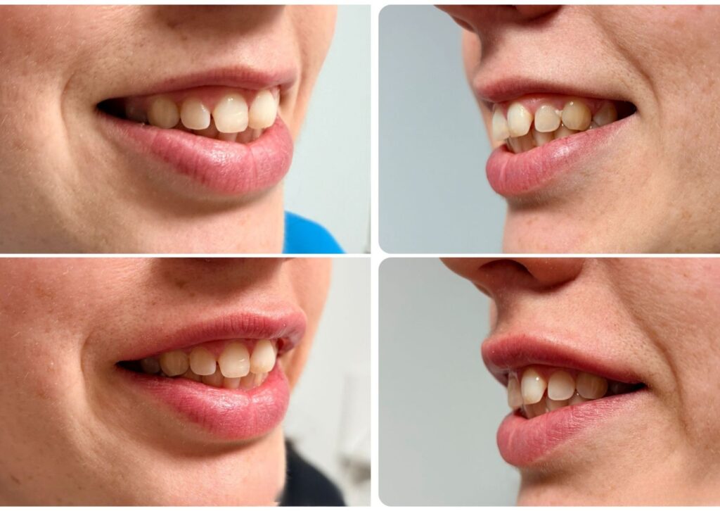 relleno labial bilbao